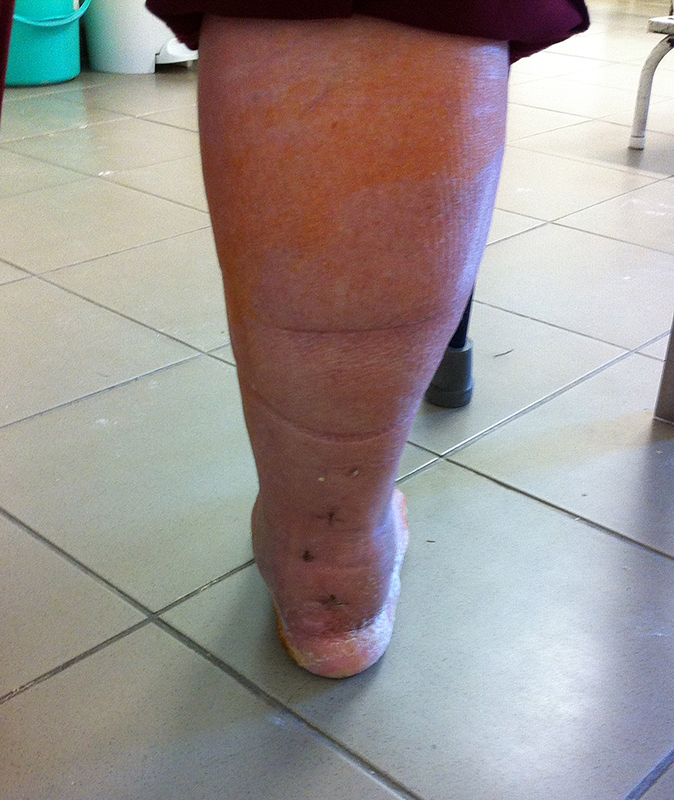 Bokaduzzanat okai - Egészség | Femina, Duzzadt bokaízületek a lábak
