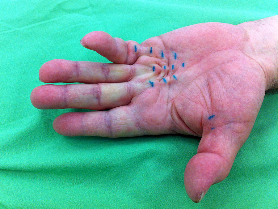 ujj műtét után a parti keresztirányú ízületek deformáló artrózisa