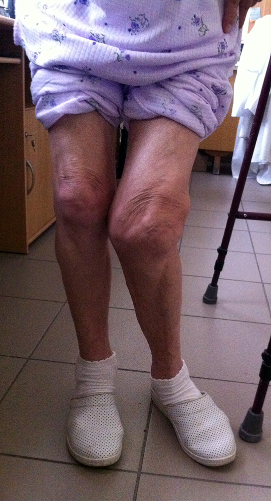 térd osteoarthrosis betegség