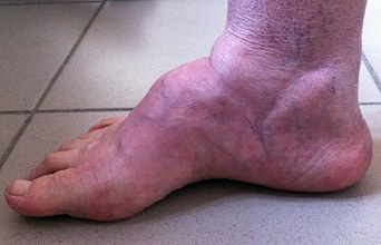 Boltíves láb (pes cavus) talaján kialakult előrehaladott arthrosis műtét előtt