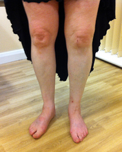 térdízület típusú betegségek ízületi fájdalom a karokban és a lábakban este